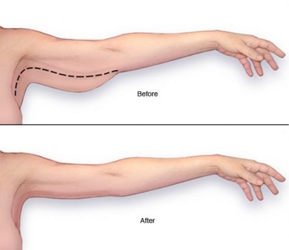 Πώς να χάσετε το λίπος από τα μπράτσα πανέυκολα