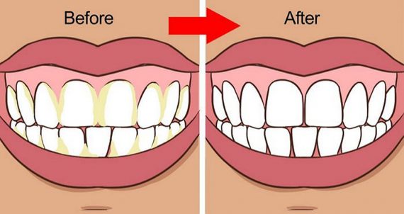 7 φυσικοί τρόποι για να καταπολεμήσετε την πλάκα και την πέτρα στα δόντια