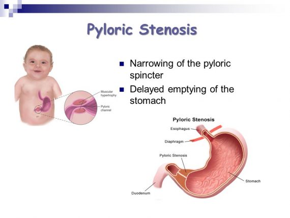 Στένωση του πυλωρού στα βρέφη