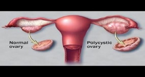 Συρρικνώστε τις κύστεις των ωοθηκών με φυσικό τρόπο!