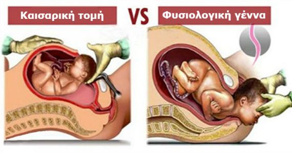 Φυσιολογικός Τοκετός vs Καισαρική Τομή: 4 Σημαντικές Αλήθειες που ΚΑΘΕ Γυναίκα θα πρέπει να Γνωρίζει!