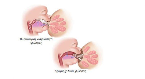 Βραχύς χαλινός γλώσσας στα νεογνά. Τι προβλήματα προκαλεί στο θηλασμό;