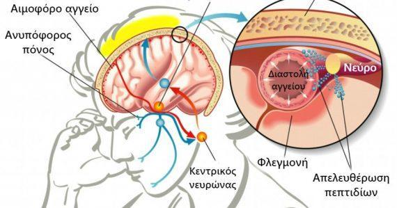 Ημικρανίες: Ποια η διαφορά από τον πονοκέφαλο – Τι τις προκαλεί – Πως θα ανακουφιστείς