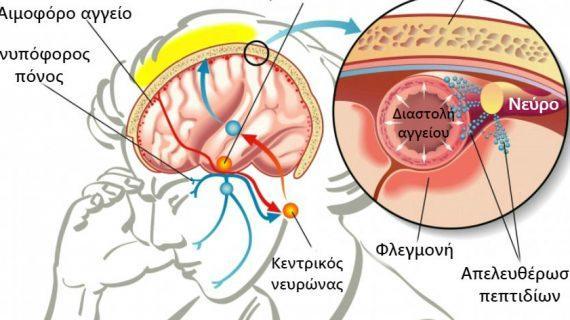 Ημικρανίες: Ποια η διαφορά από τον πονοκέφαλο – Τι τις προκαλεί – Πως θα ανακουφιστείς