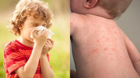Παιδιά και αλλεργίες – Τα συμπτώματα και τι τις πυροδοτεί όλα όσα πρέπει να ξέρουν οι γονείς