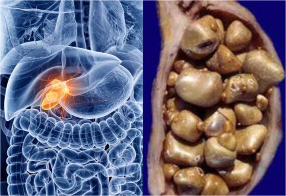Πέτρες στη χολή ή Χολολιθίαση: Ποια είναι τα συμπτώματα και ποια η θεραπεία