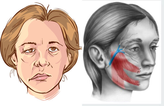 Πάρεση προσώπου: Τι μπορεί να την προκαλέσει και ποια τα συμπτώματα