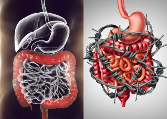Σύνδρομο ευερέθιστου εντέρου: Τι είναι ποια τα συμπτώματα και πως αντιμετωπίζεται