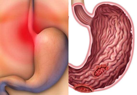 Πεπτικό έλκος: Τι είναι ποια τα συμπτώματα και πως αντιμετωπίζεται