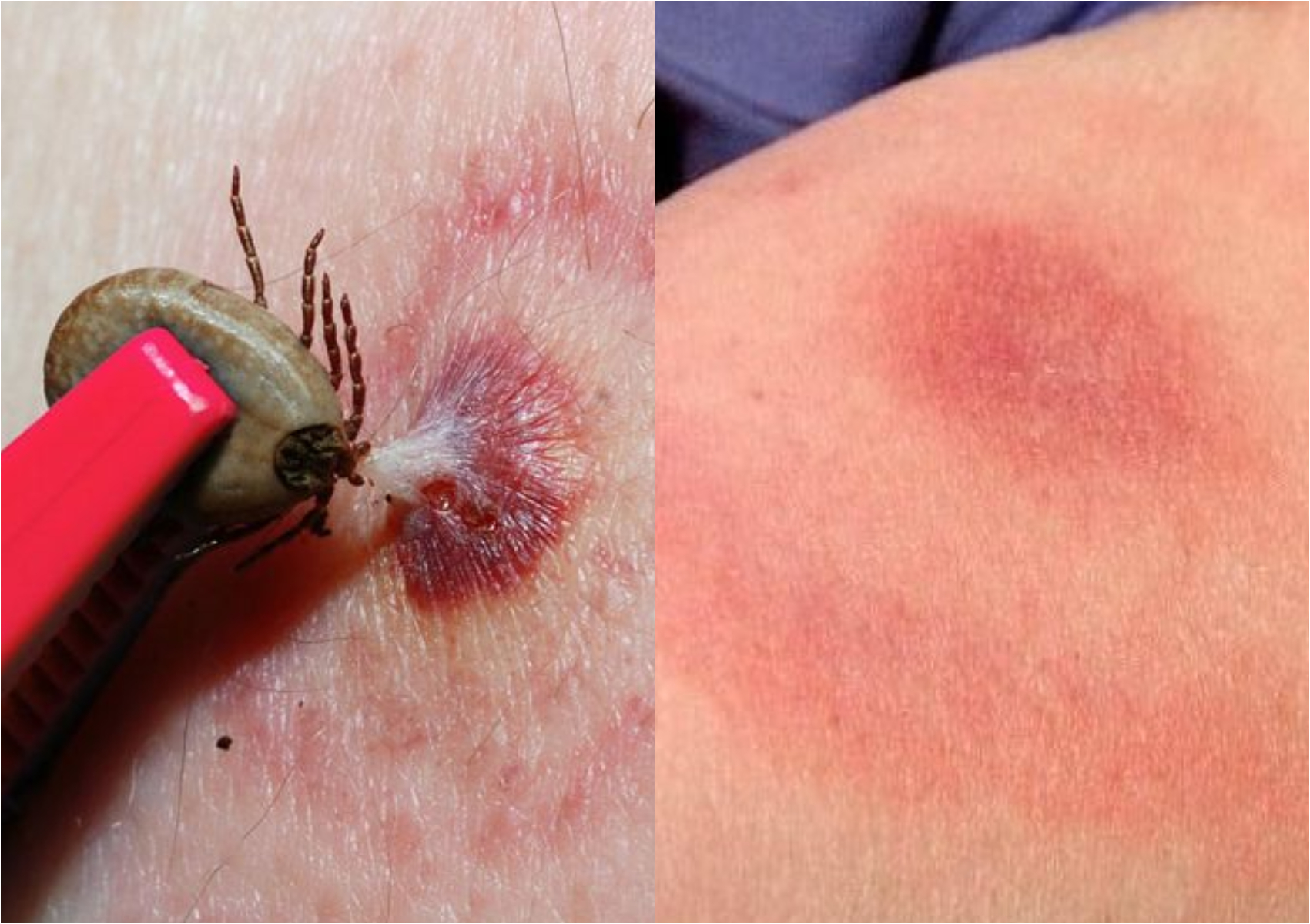 Νόσος του Lyme ή Βορρελίωση: Τα συμπτώματα και η θεραπεία της σοβαρής ασθένειας από τσιμπούρια 