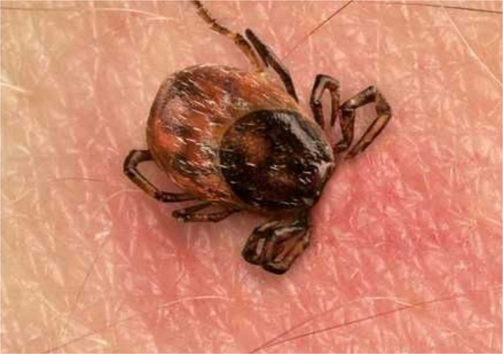 Νόσος του Lyme ή Βορρελίωση: Τα συμπτώματα και η θεραπεία της σοβαρής ασθένειας από τσιμπούρια 