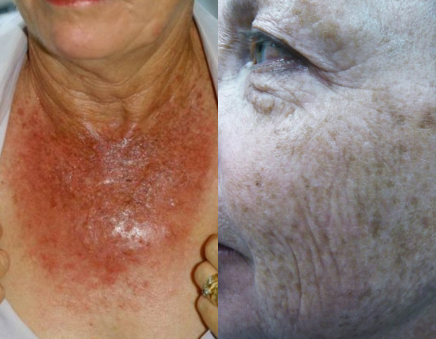 Φωτογήρανση: Οι συνέπειές της στο δέρμα και anti-aging tips από την Δερματολόγο Δρ Αμαλία Τσιατούρα
