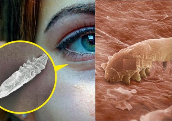 Demodex ή Δεμόδικας: Τα αόρατα αραχνοειδή ακάρεα που ζουν στο πρόσωπό μας και ποια προβλήματα υγείας προκαλούν