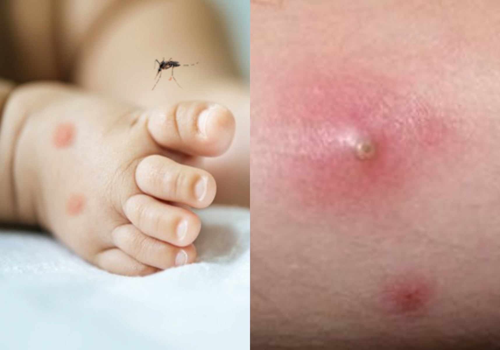 Τσιμπήματα κουνουπιών στα παιδιά: Μολύνονται από βρωμιά άμμο και ξύσιμο προκαλώντας ως και σταφυλόκοκκο