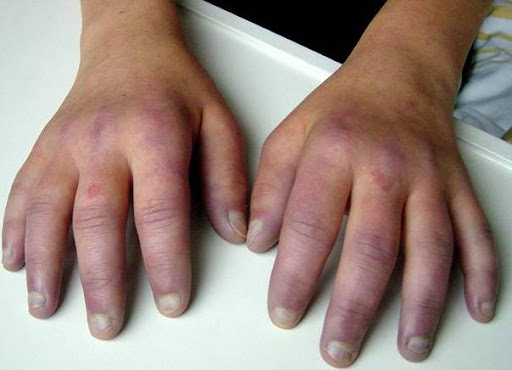 Σύνδρομο Raynaud-test-