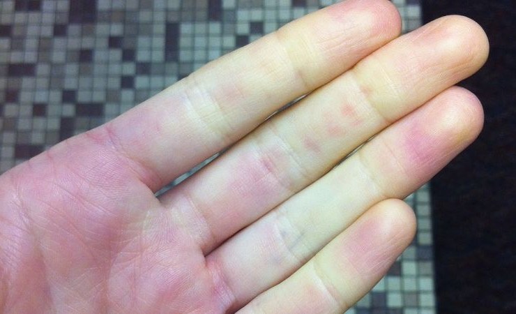 Σύνδρομο Raynaud-test-