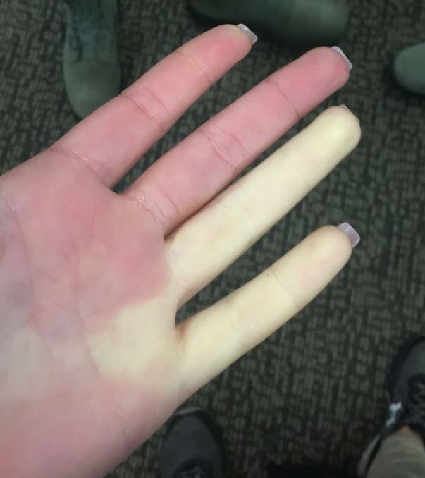 Σύνδρομο Raynaud-test-