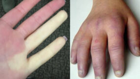 Σύνδρομο Raynaud-test-