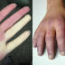 Σύνδρομο Raynaud-test-